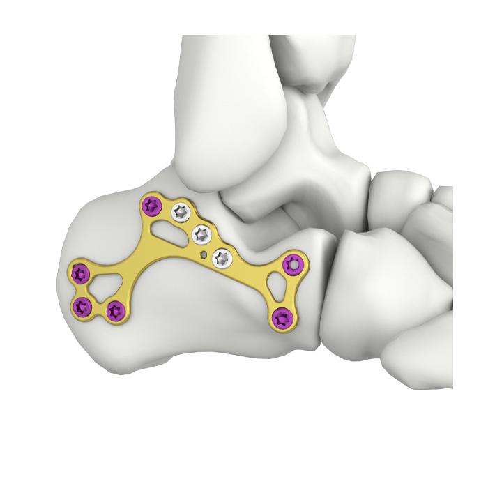 Itval calcaneus-MIS-lockplaat