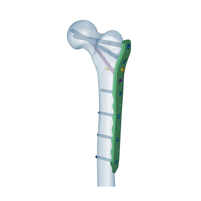 Proximale femurbevestigingsplaat