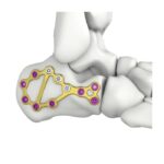 Itval calcaneus-lockplaat