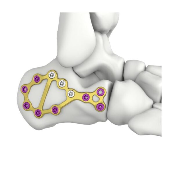 Itval calcaneus-lockplaat
