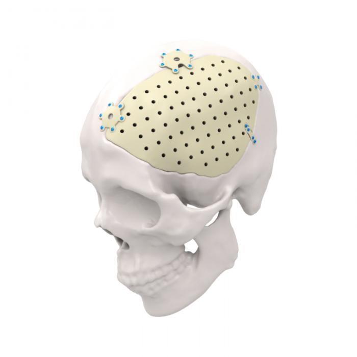 Gepersonaliseerd PEEK & Titanium Patiëntspecifiek Implantaat voor Craniale Reparatie en Constructie